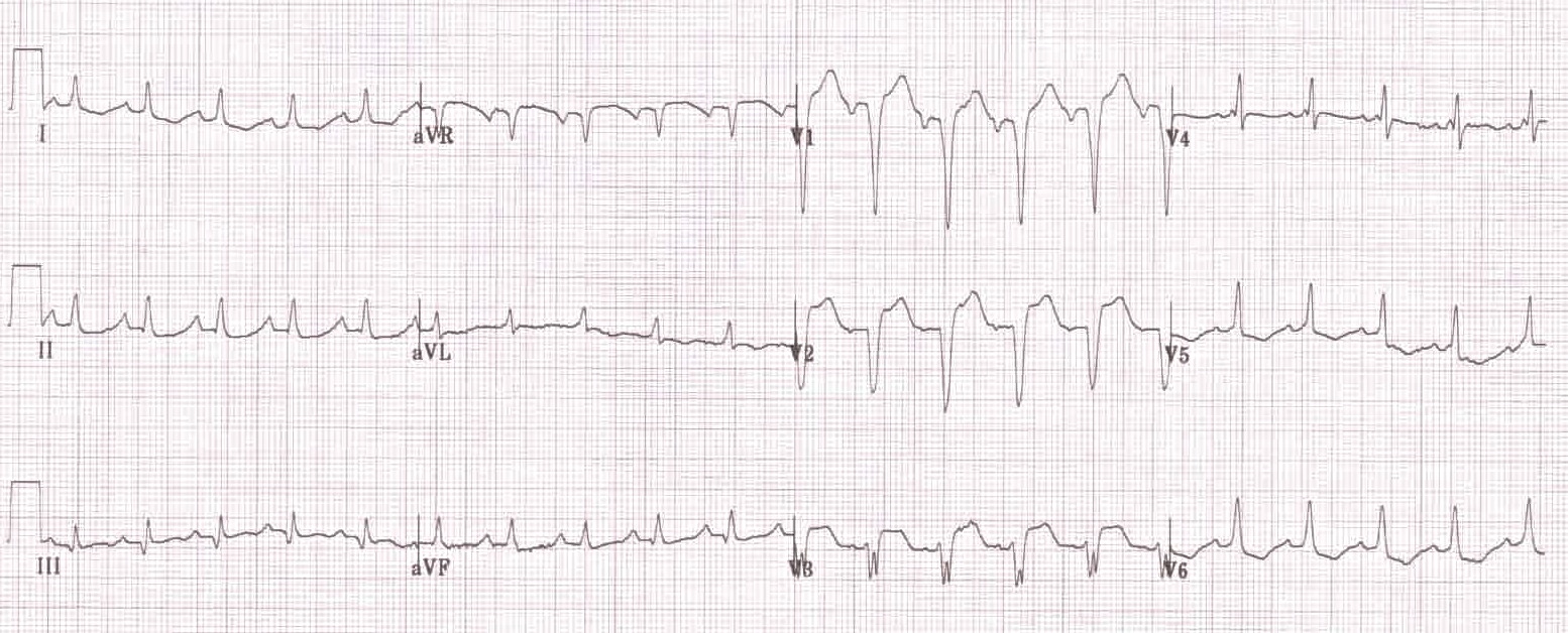 İnkomplet sol dal bloğu (QRS süresi 110 ms). Kaynak : lifeinthefastlane.com - ECG library