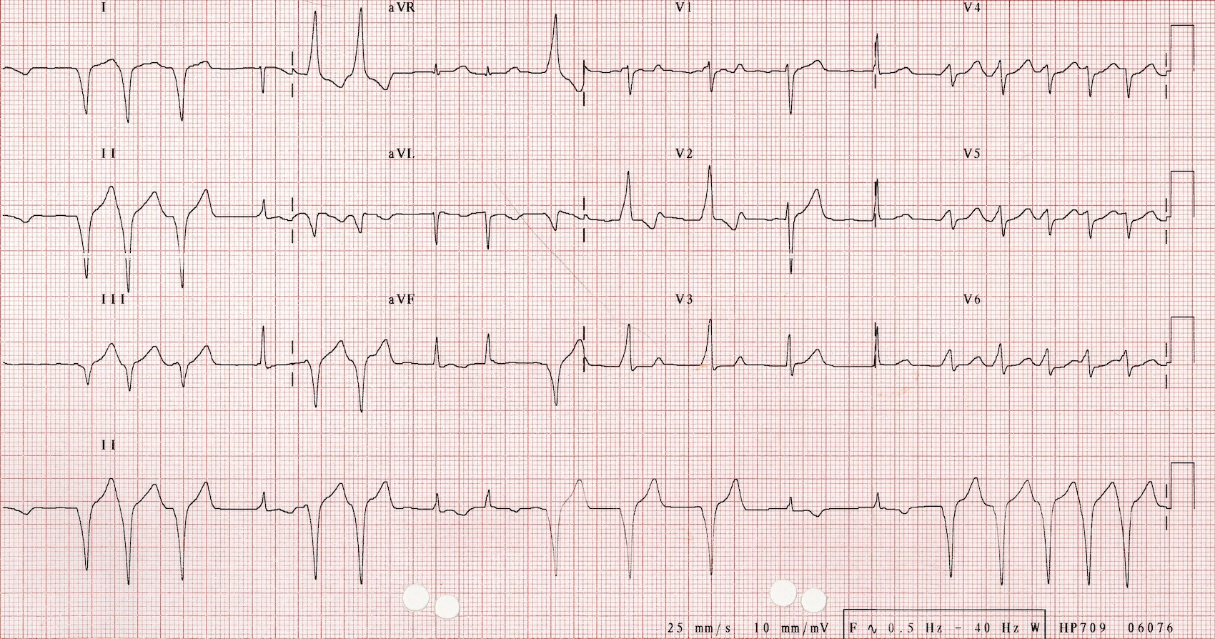 Kaynak : lifeinthefastlane.com - ECG library