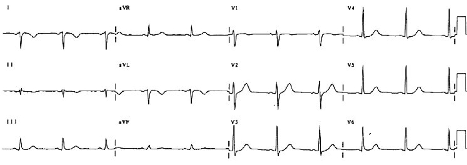 Dekstrokardiyi taklit eden LA/RA yer değişimi. Kaynak : lifeinthefastlane.com - ECG library