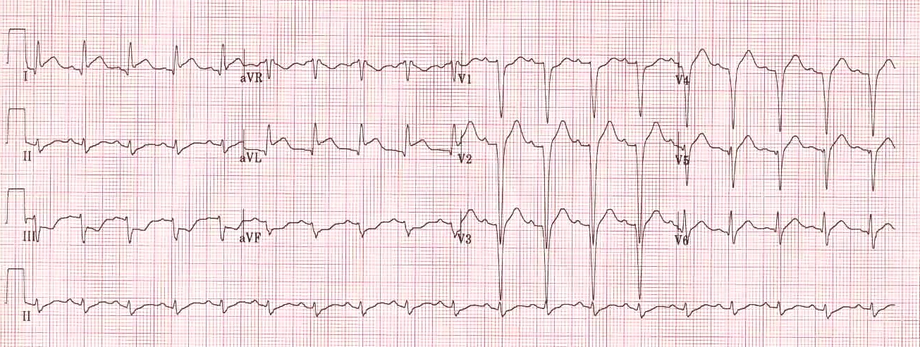 Kaynak : lifeinthefastlane.com - ECG library