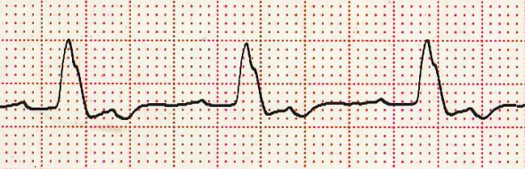 Çentikli R dalgası Kaynak : lifeinthefastlane.com - ECG library