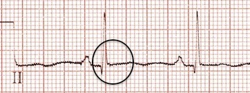 II. derivasyondaki retrograd P dalgaları ortadan kalkmış. Kaynak : lifeinthefastlane.com - ECG library