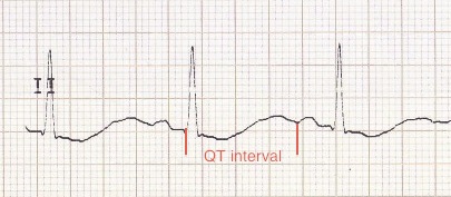 Hipokalemi 2 Hipokalemi ile birlikte belirgin uzun QT aralığı (gerçekte T-U füzyonu) Kaynak : lifeinthefastlane.com - ECG library