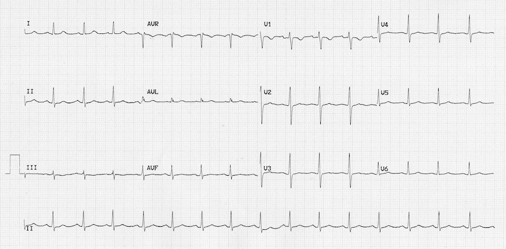Kaynak : lifeinthefastlane.com - ECG library
