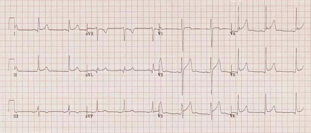Kaynak : lifeinthefastlane.com ECG library