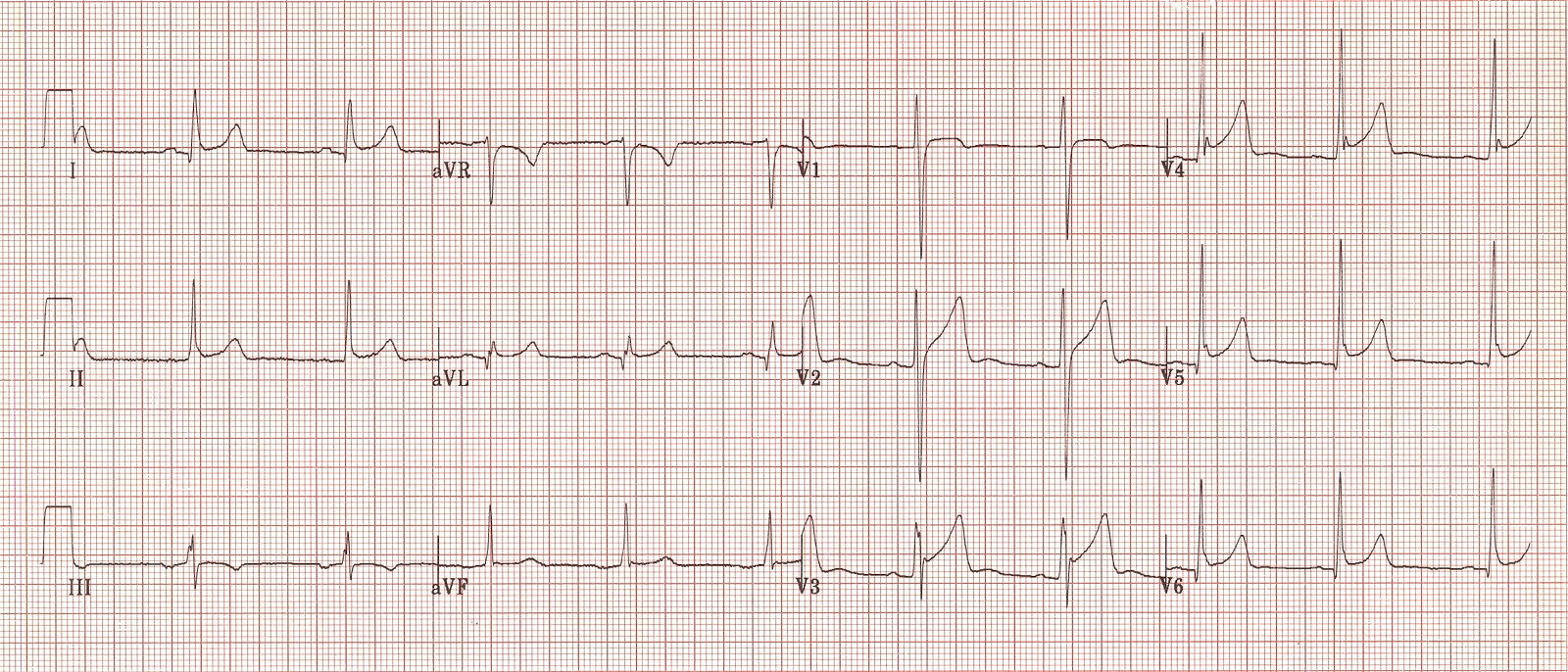 Kaynak : lifeinthefastlane.com ECG library