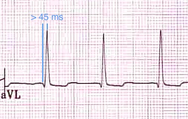aVL'de > 45 ms uzamış R-dalga pik süresi (= QRS başlangıcından R dalga pikine kadar geçen süre). Kaynak : lifeinthefastlane.com - ECG library
