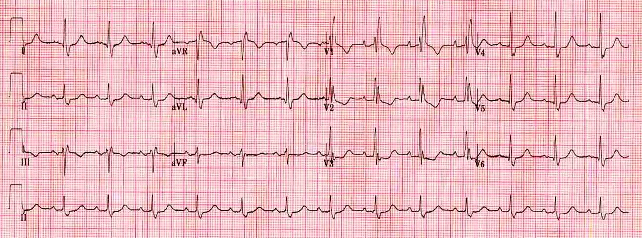 Kaynak : lifeinthefastlane.com - ECG library