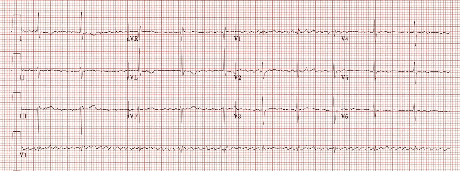 Kaynak : lifeinthefastlane.com - ECG library
