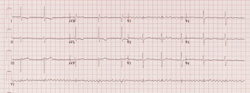 Kaynak : lifeinthefastlane.com - ECG library