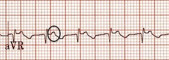aVR'de yukarı dönük P dalgaları Kaynak : lifeinthefastlane.com - ECG library