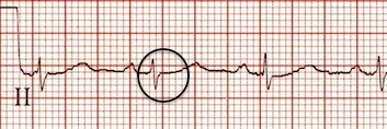 II. derivasyondaki retrograd P dalgaları ortadan kalkmış. Kaynak : lifeinthefastlane.com - ECG library