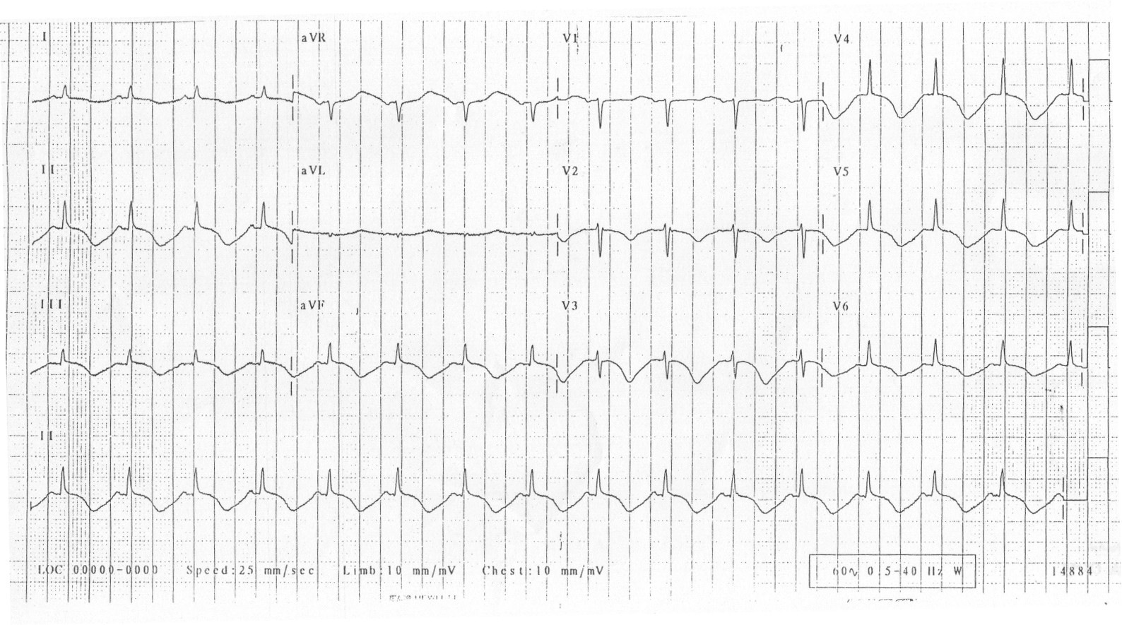 Kaynak : lifeinthefastlane.com - ECG library