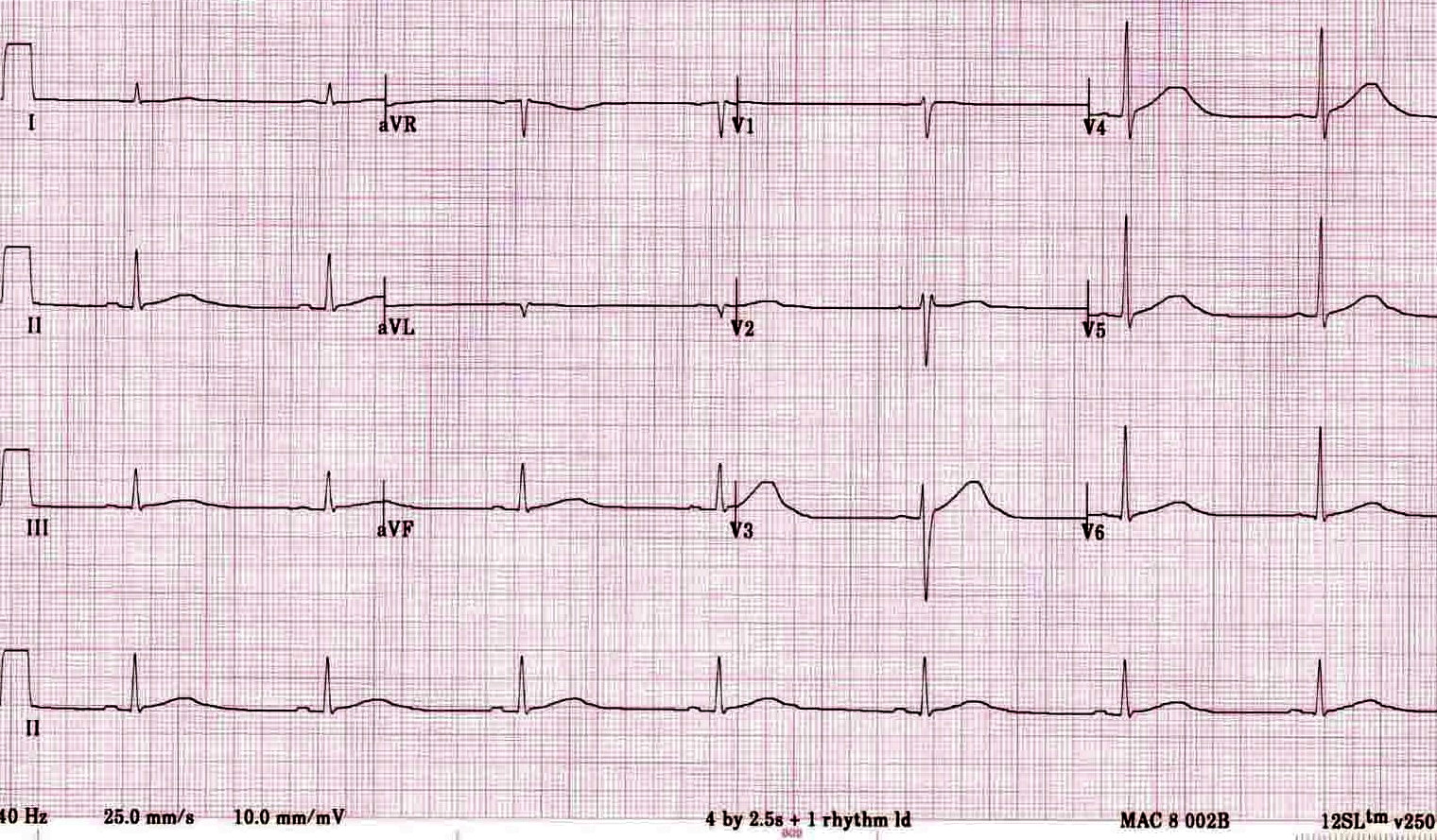 Kaynak : lifeinthefastlane.com - ECG library