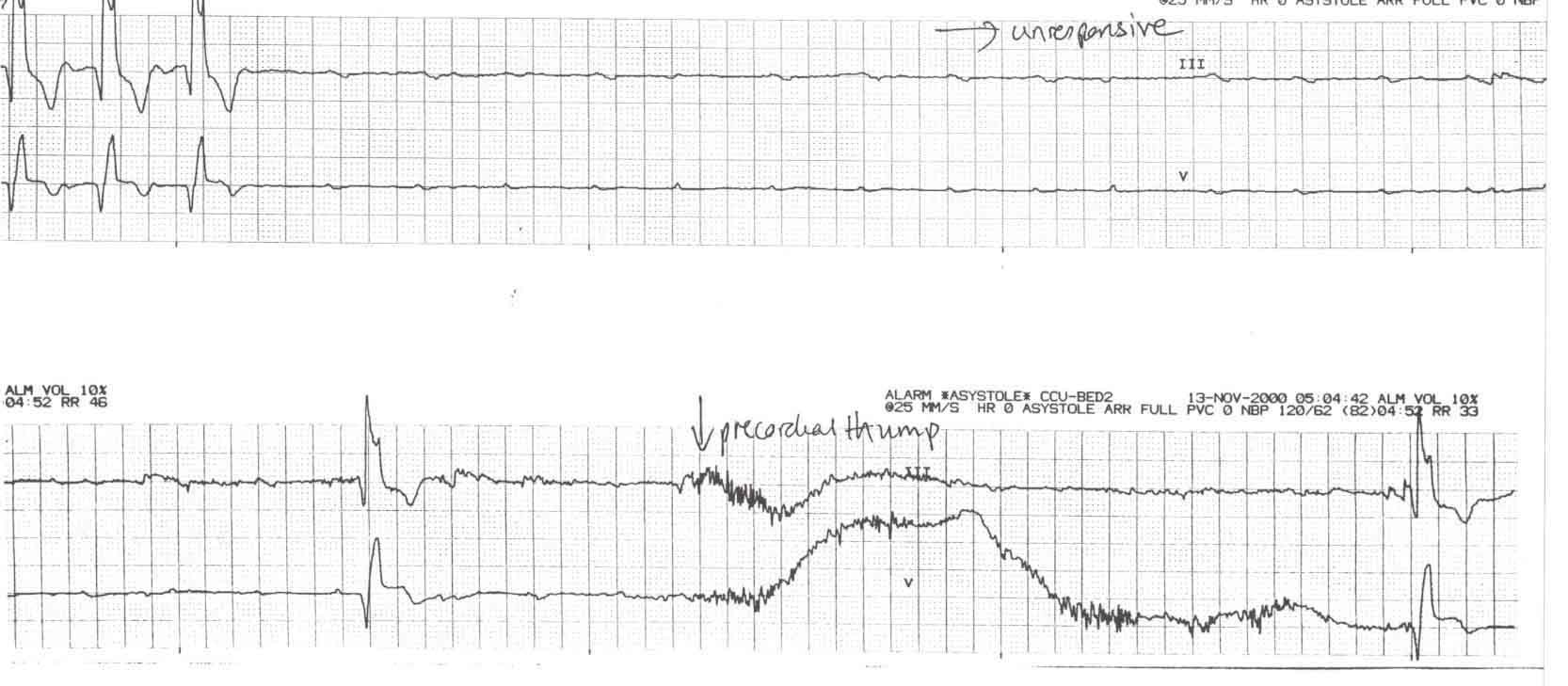 Kaynak : lifeinthefastlane.com - ECG library