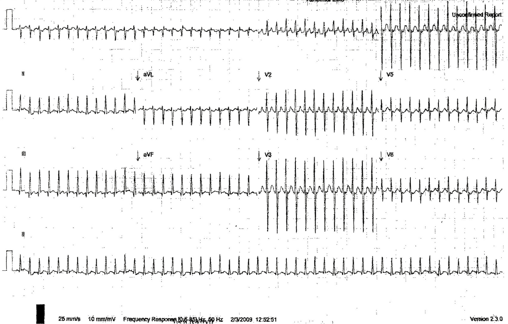 Kaynak : lifeinthefastlane.com - ECG library