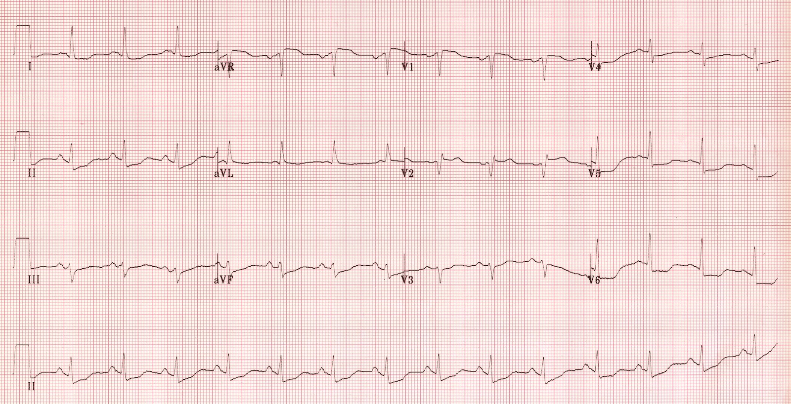 Kaynak : lifeinthefastlane.com - ECG library