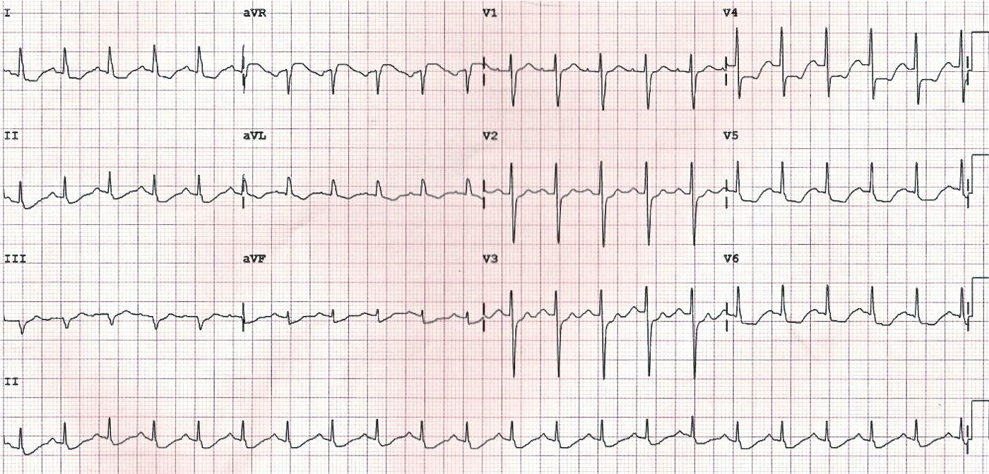 LMCA tıkanıklığına bağlı yaygın subendokardiyal iskemi. Kaynak : lifeinthefastlane.com - ECG library