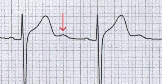 Adolesanda normal U dalgası. Kaynak : lifeinthefastlane.com - ECG library