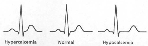 calcium-t-wave-changes