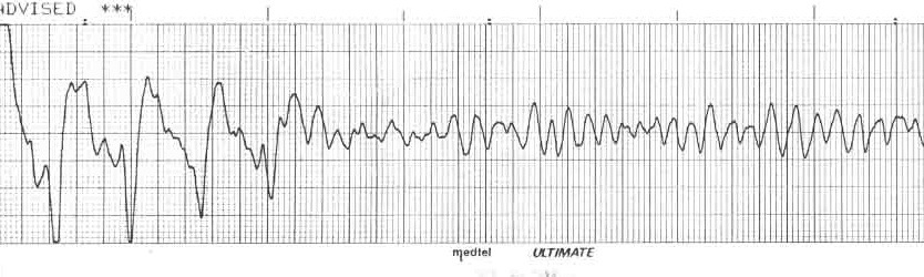 Kaynak : lifeinthefastlane.com - ECG library