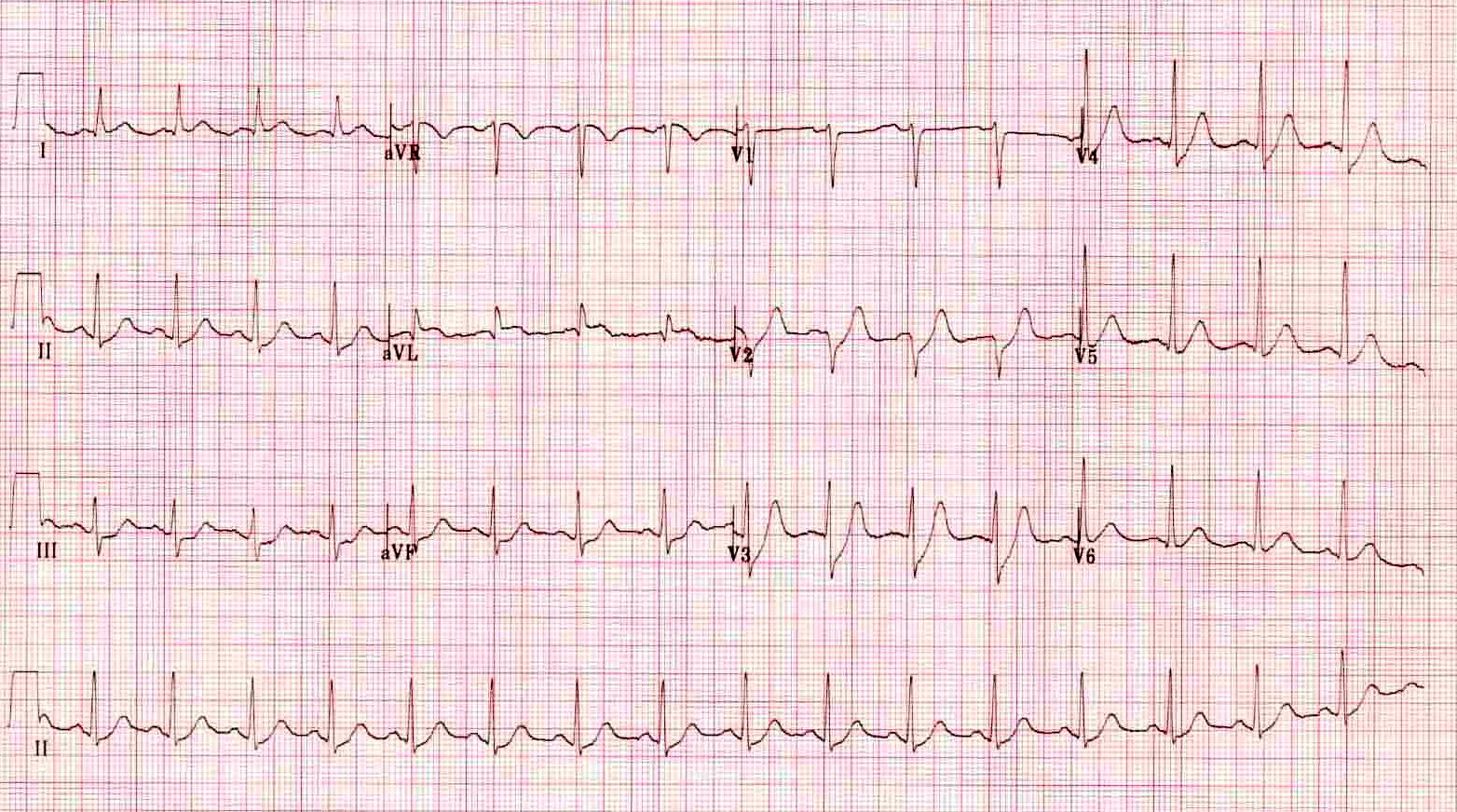 Kaynak : lifeinthefastlane.com - ECG library