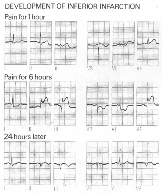 Kaynak : lifeinthefastlane.com - ECG library