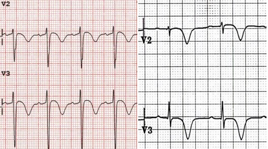 Kaynak : lifeinthefastlane.com - ECG library