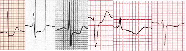 Miyokardiyal iskemide ST segment patternleri Kaynak : lifeinthefastlane.com - ECG library