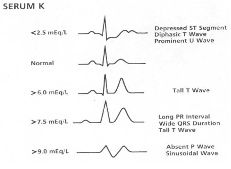 potassium-spectrum-of-ecg-changes