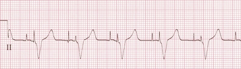 Atriyal ve ventriküler pace spikeları Kaynak : lifeinthefastlane.com - ECG library