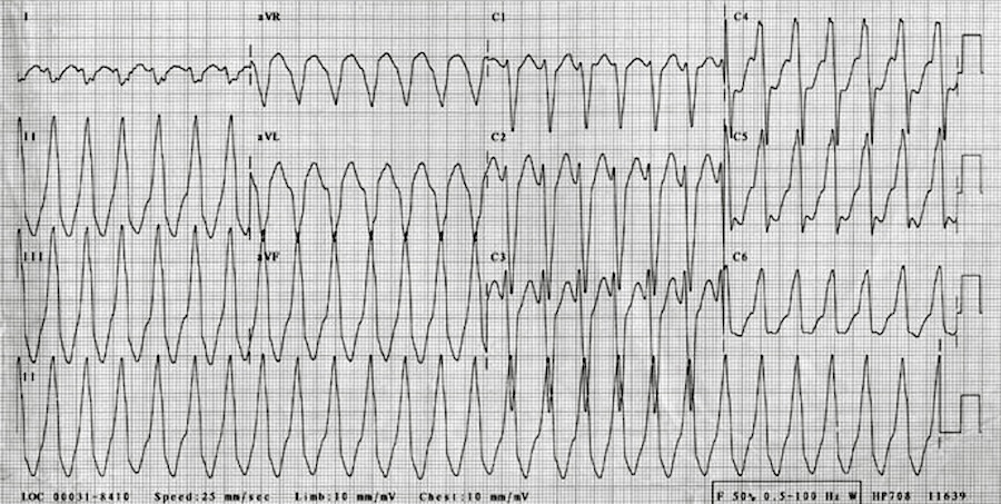 Kaynak : lifeinthefastlane.com - ECG library
