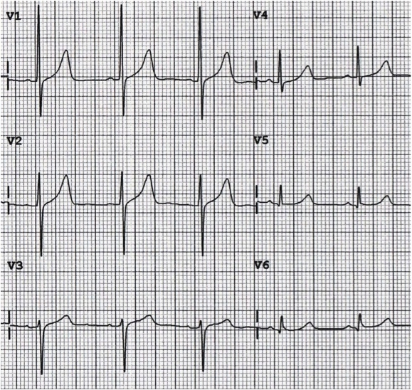 Kaynak : lifeinthefastlane.com - ECG library