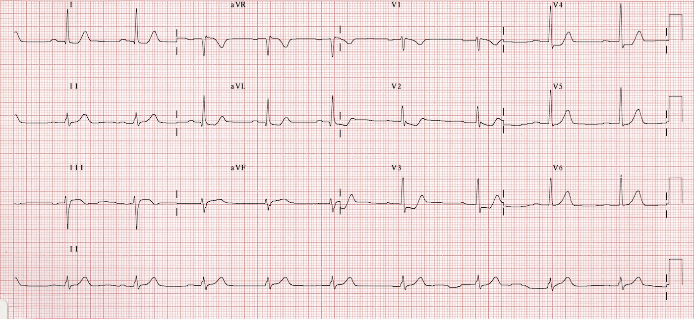 Kaynak : lifeinthefastlane.com - ECG library