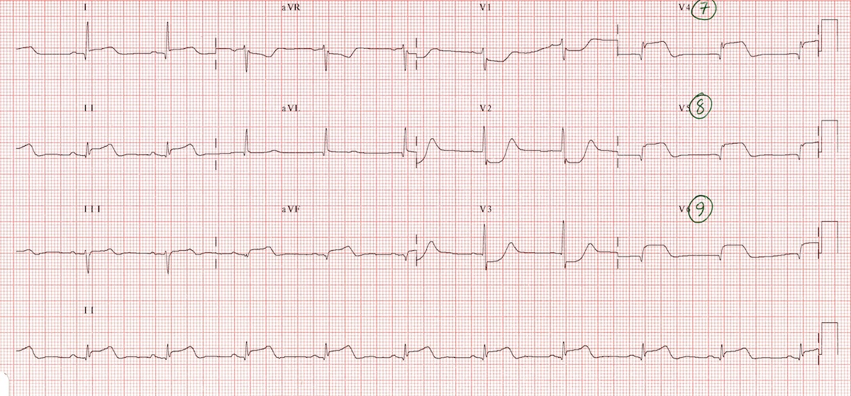 KLKaynak : lifeinthefastlane.com - ECG library