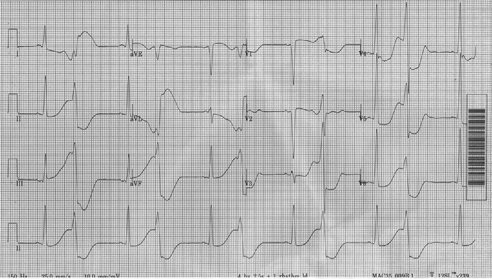 Kaynak : lifeinthefastlane.com - ECG library
