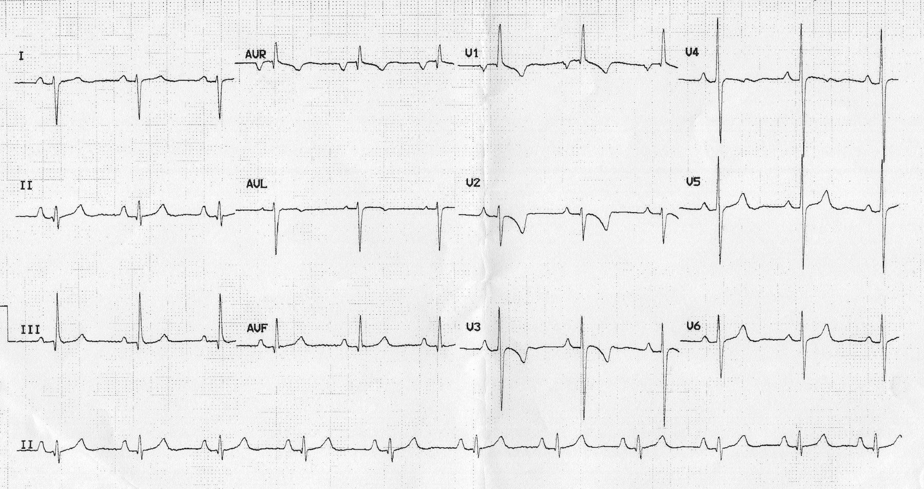 3 derecelik hipertansiyon durumunda EKG