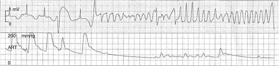Kaynak : lifeinthefastlane.com - ECG library