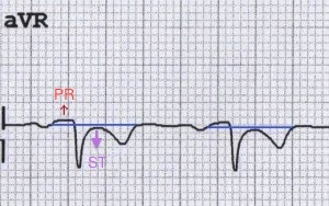 aVR'de resiprokal PR elevasyonu ve ST çökmesi. Kaynak : lifeinthefastlane.com - ECG library