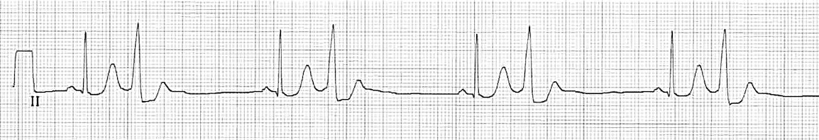 Kaynak : lifeinthefastlane.com - ECG library