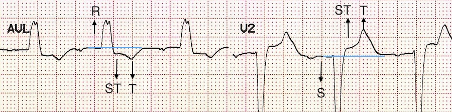 Uygun diskordans Kaynak : lifeinthefastlane.com - ECG library