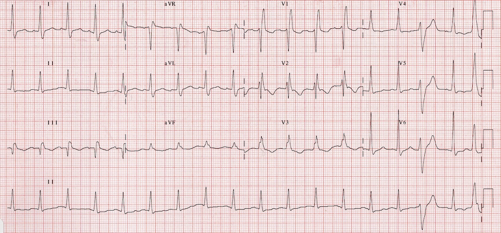 Kaynak : lifeinthefastlane.com - ECG library