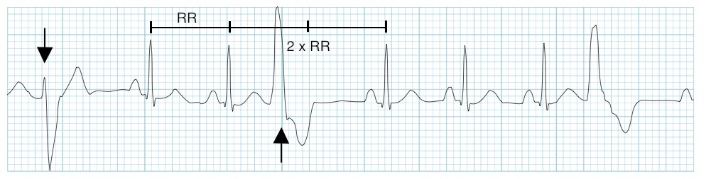 Kaynak : lifeinthefastlane.com - ECG library com
