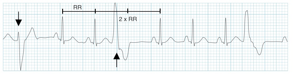 Kaynak : lifeinthefastlane.com - ECG library com