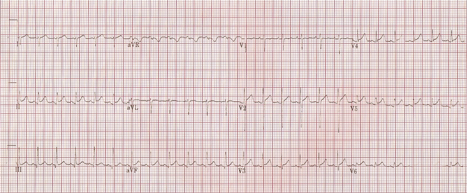 Kaynak : lifeinthefastlane.com - ECG library