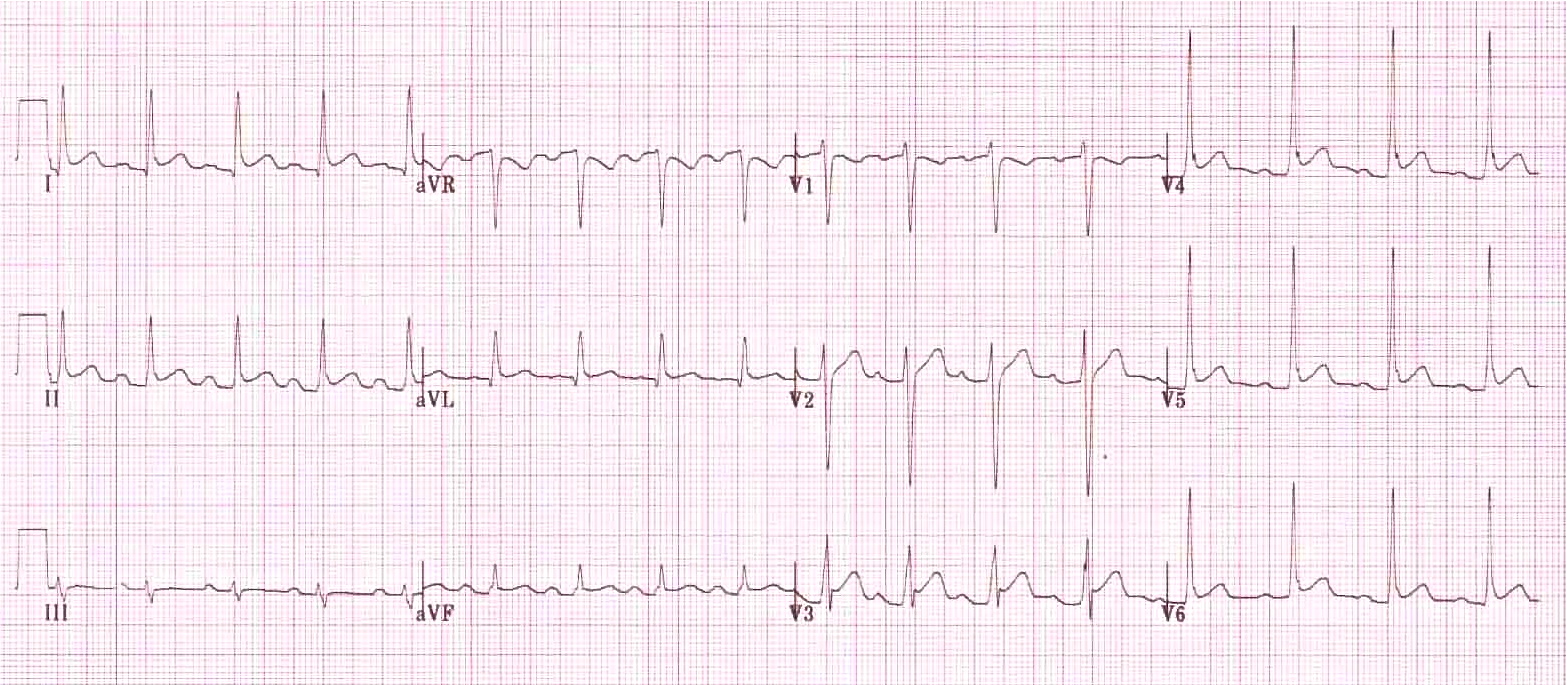 Kaynak : lifeinthefastlane.com - ECG library