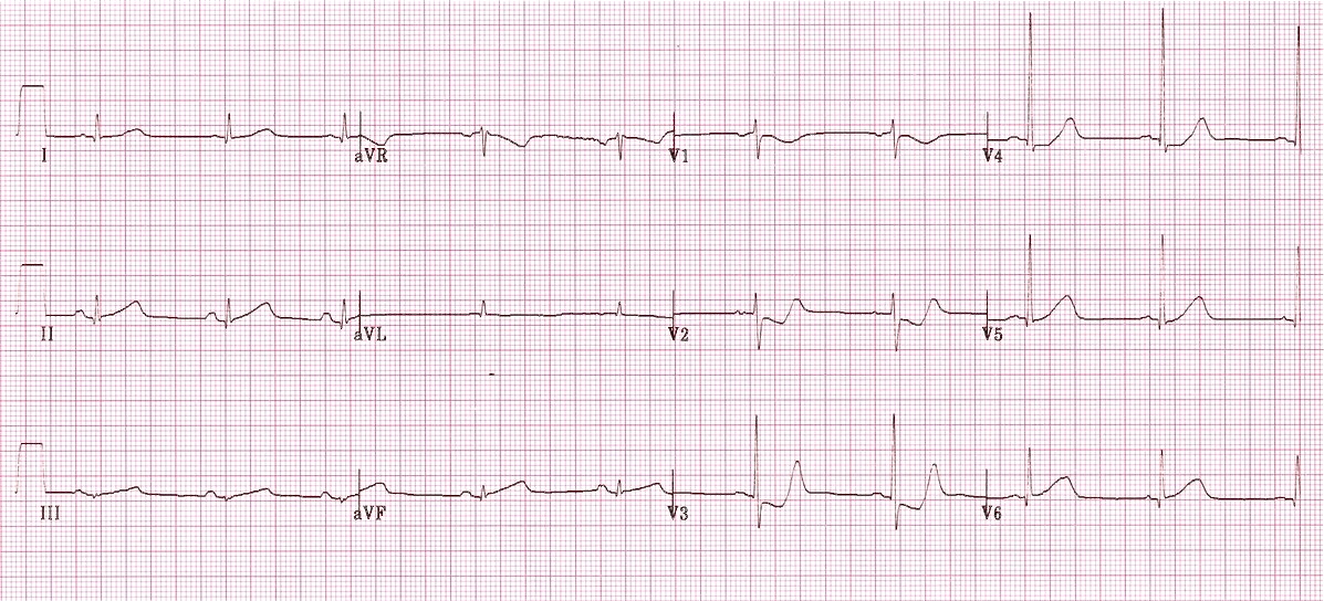 Kaynak : lifeinthefastlane.com - ECG library