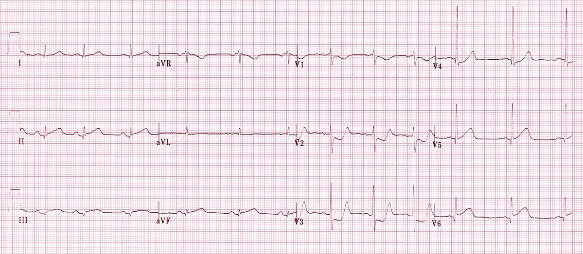 Kaynak : lifeinthefastlane.com - ECG library
