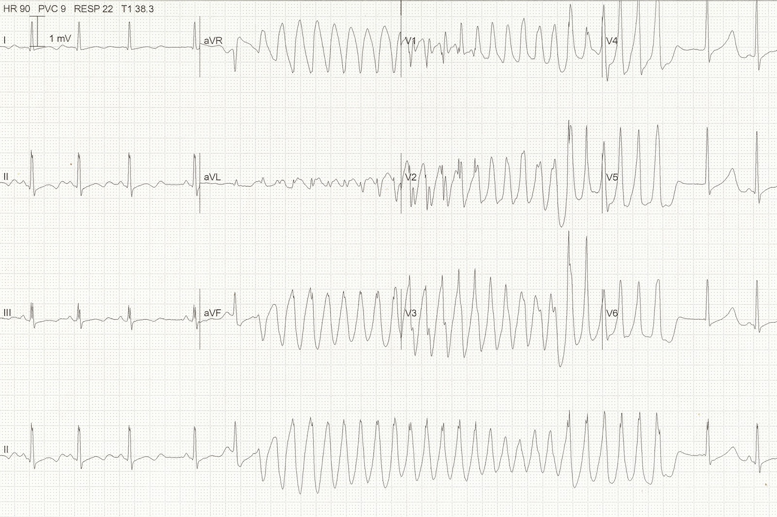 Kaynak : lifeinthefastlane.com - ECG library