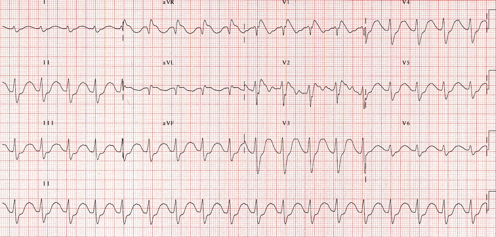 Kaynak : lifeinthefastlane.com - ECG library